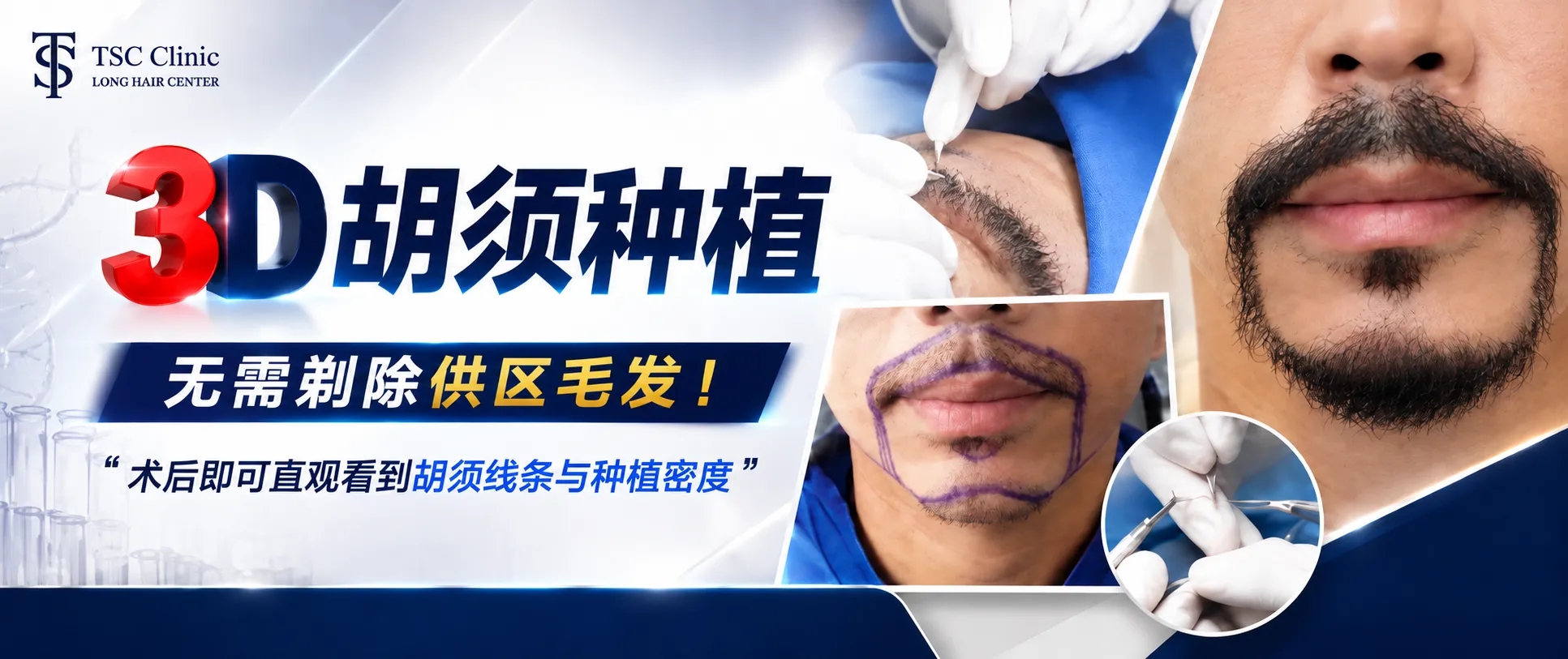 3D Long Hair FUI胡须移植|Dr.Top Hair Hospital无剃发技术